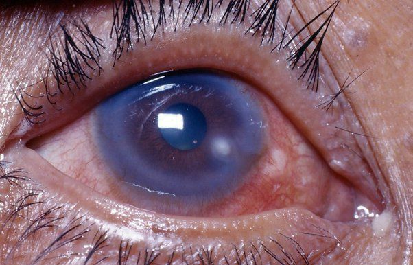 What should you do if you get coolant in your eyes?