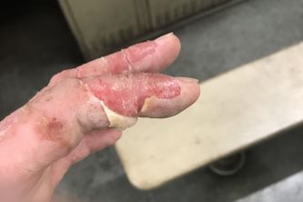 Is coolant safe on skin?